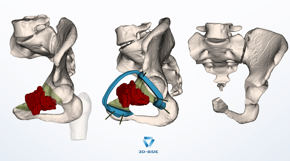 Periacetabular Chondrosarcoma: Why the First Resection Is the Only One That Counts