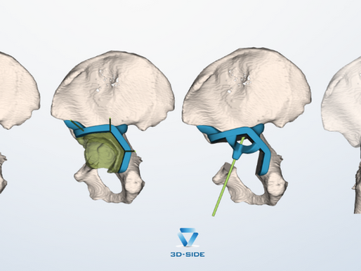 3D reconstruction of a pelvis showing tumor involvement of the acetabulum, planned resection planes, and patient-specific surgical guides for precise bone cutting and reconstruction.