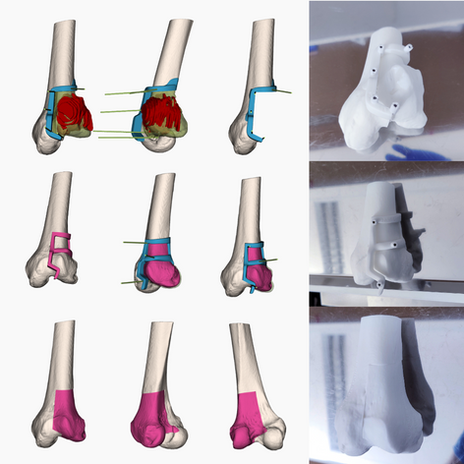 A patient with a femoral tumor located near the joint line