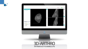 What if pre-op planning gave every ankle its own surgical roadmap?