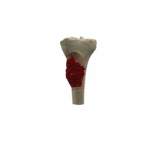 Accurate resection of bone tumor and preservation of knee extension with patient-specific guides