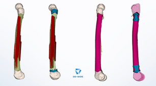 3D planning render of a femoral tumor along the bone shaft, shown before resection and allograft reconstruction"