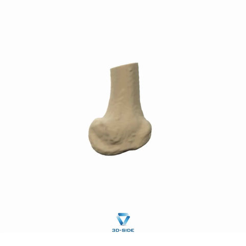 Distal Femur Closing Wedge Osteotomy