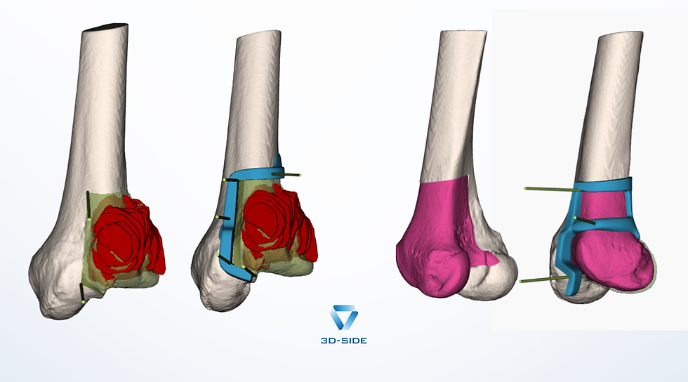 Successful Femoral Tumor Resection with Patient-Specific Guide and Allograft Reconstruction