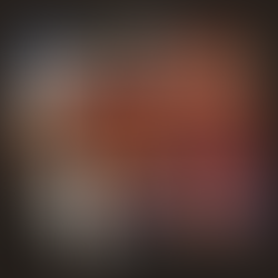 Intraoperative tumor resection and extracted osteochondroma specimen, confirming R0 margins.