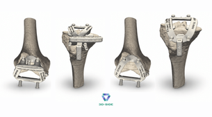 Four views of 3D-Arthro Knee patient-specific cutting guides fitted on femoral implant components, showing the same guide architecture from different angles