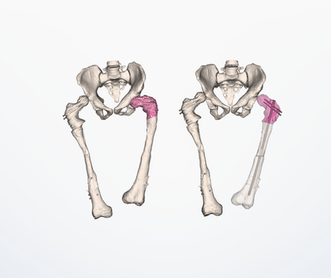 3D planning and surgical guides for proximal femoral correction in fibrous dysplasia, including preoperative deformity analysis, resection guide, entry-point guide for intramedullary nail insertion, aligner guide with cross-osteotomy K-wires, and postoperative reconstruction.