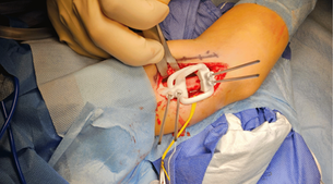 Patient-Specific Guide for Corrective Osteotomy: Closing an Angle and a Rotation in One Move