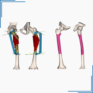 Clinical Case: Resection and Reconstruction of Ewing’s Sarcoma with Pathological Fracture