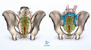 A Sacral Tumor Resection: Breaking the Bone Where a Saw Blade Can't Reach