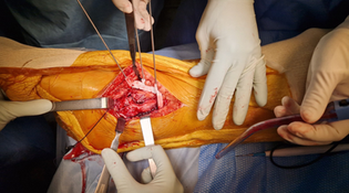 Distal Tibia Tumor Resection: Two Guides Built as Geometric Counterparts