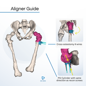 Aligner guide with cross-osteotomy K-wires maintaining multiplanar proximal femoral correction during intramedullary nail insertion.