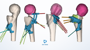 Patient-specific guides for femoral neck osteotomy — 3D planning views, Case #03438, Dr. Wudbhav Sankar, Children's Hospital of Philadelphia