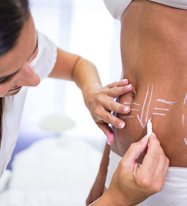 cirurgiao-desenhando-linhas-no-abdomen-da-mulher-para-remocao-de-lipoaspiracao-e-celulite-