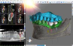 Implantologia computer guidata