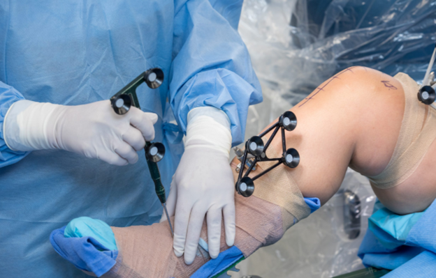 Orthopedic surgeon using Mako robotic system with optical navigation trackers during total knee replacement procedure in operating room