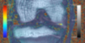 HPR OA MRI