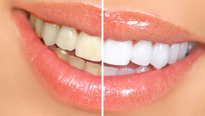 50% Off Teeth Whitening