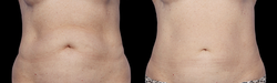 body-sculpting-8
