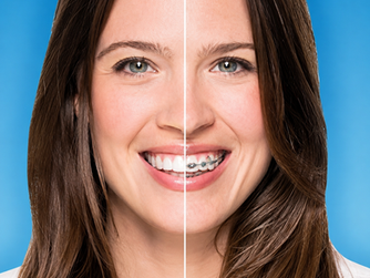 Why More Hornsby Families Are Choosing Invisalign Over Traditional Braces