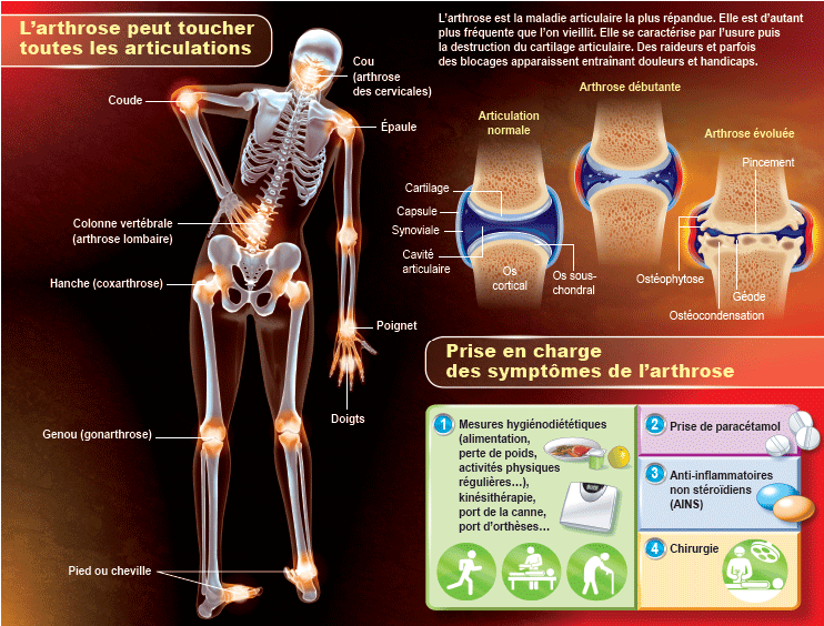 Tout savoir sur l'arthrose