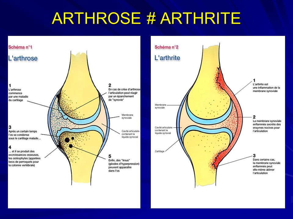Quelle différence y atil entre l'arthrose et l'arthrite Quelle différence y atil entre l'arthrose et l'arthrite
