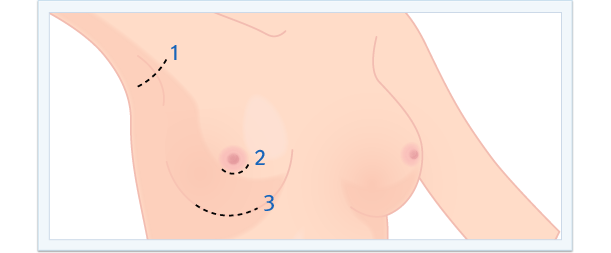 Cirugía Plástica, estética, aumento de mamas, reducción de mamas, elevación de mamas (mastopexia), mamas tuberosas, sevilla, jerez de la Frontera