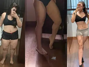 Obesidade é doença crônica e lipedema pode estar por trás de dores e inchaço nas pernas