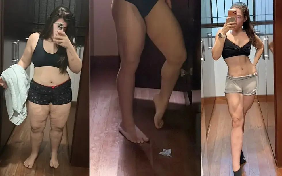 Obesidade é doença crônica e lipedema pode estar por trás de dores e inchaço nas pernas