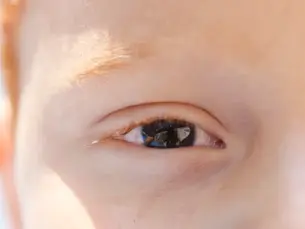 Fotoceratite exige cuidados redobrados no verão