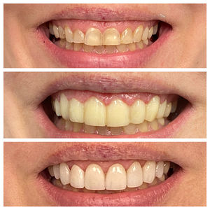 Veneers+ gingivectomy