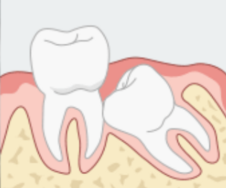 After Wisdom Teeth Extraction