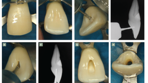 ENDO 1 - Acesso ao sistema de canais radiculares (SCR) - dentes uni e birradiculares 