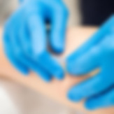 dry-needling-sioux-falls-physical-therapy
