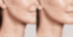 Before and After of Hydrafacial HydraFillic Booster at LaVida Smithtown
