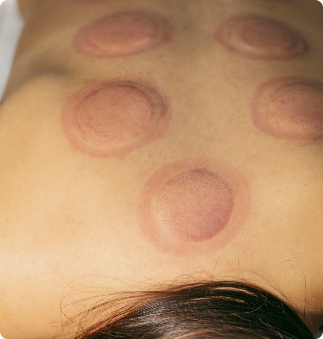 cupping-3.png