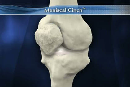 meniscal_cinch_animation_03-03-08_267.mp4