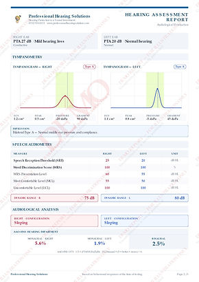 Sample hearing assessment report, page 2: tympanometry and speech audiometry results