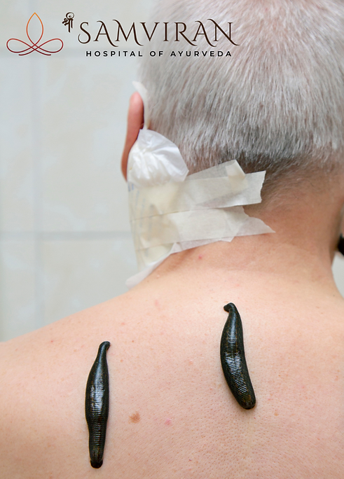 Leech therapy