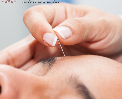 Viddha karma - Accupuncture