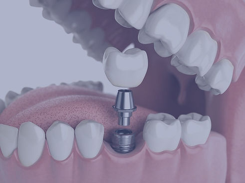dental-implants-1024x768_edited.jpg