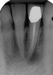 root canals