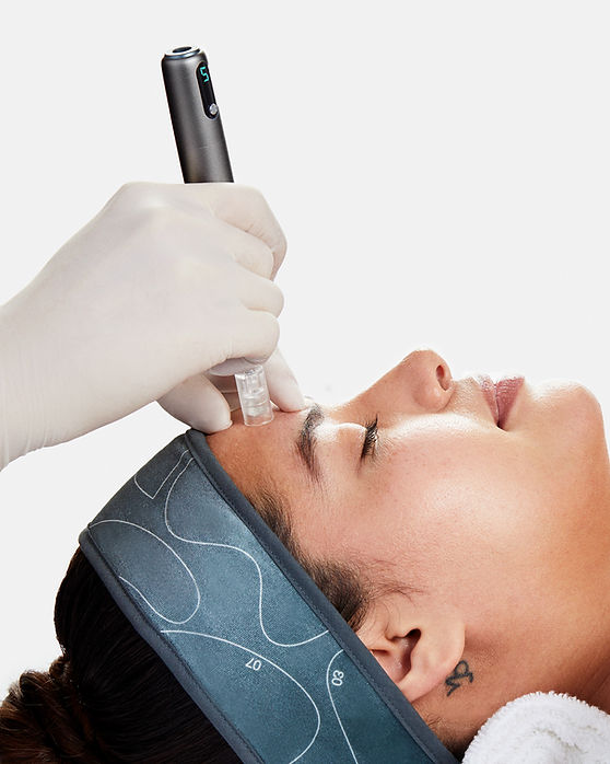 Women getting microneedling