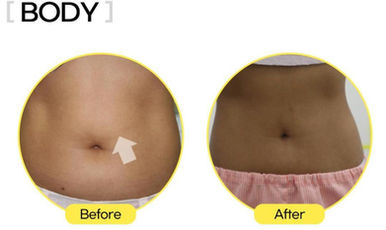 Before and after images of stomach for lemon bottle treatment