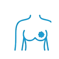 breast_cancer.png