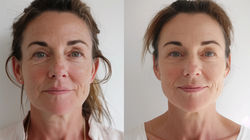 Before and After RF Microneedling