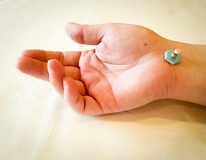 Moxibustion on a hand
