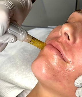 microneedling-face.jpg
