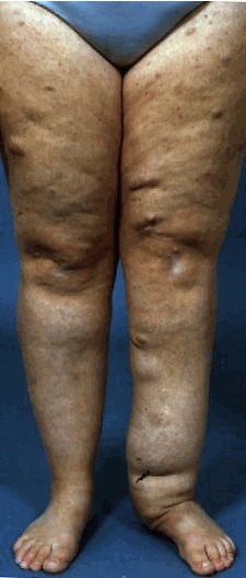 Neurofibroma plexiforme