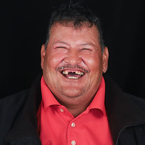 Patient (before dental implants)